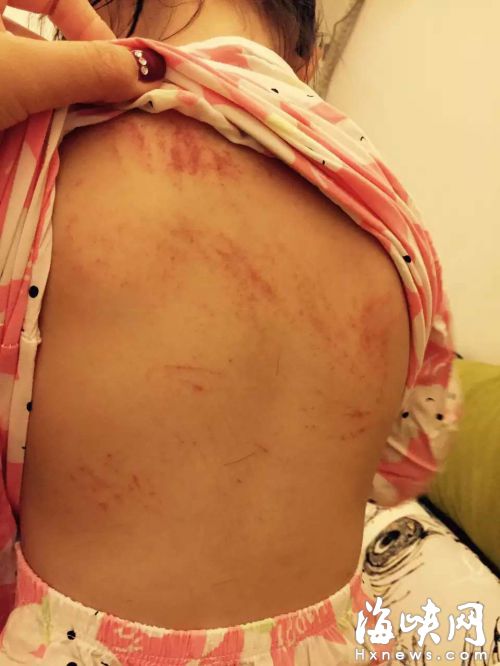 3岁女童满身伤说“被老师打” 监控故障无法调取